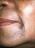 taches hyperpigmentation