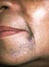 taches hyperpigmentation