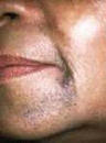 taches hyperpigmentation